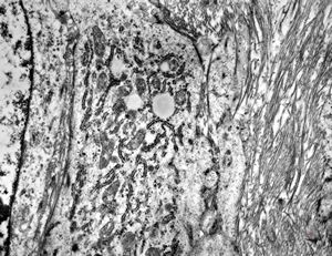 F,17y. | neck - rhabdomyosarcoma